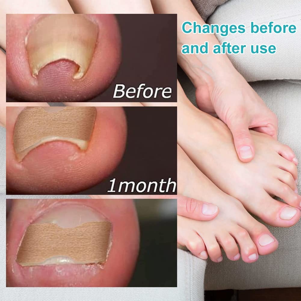 🦶✨ Parche Corrector de Uñas Encarnadas – Pack x50 unidades