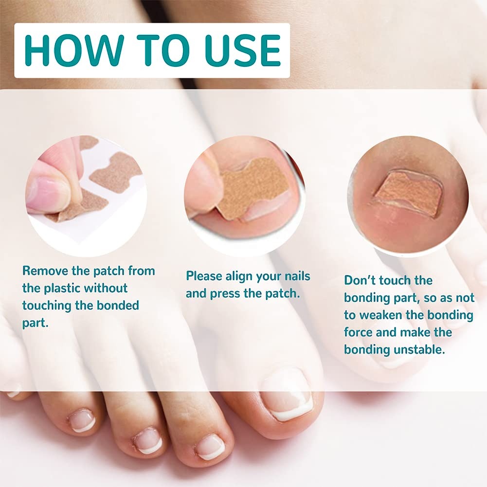 🦶✨ Parche Corrector de Uñas Encarnadas – Pack x50 unidades
